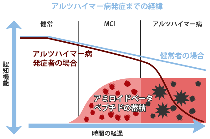 アルツハイマー病発症までの経緯